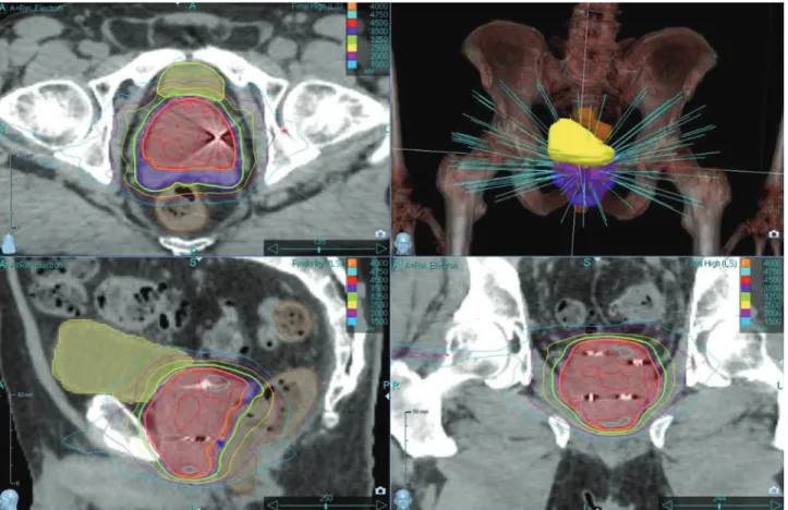 1. ÁBRA. Dóziseloszlások három síkban, illetve a sugárnyalábok elrendezésének virtuális képe (jobb felső kép) egy közepes kockázatú beteg  szimultán integrált „boost”-os besugárzási tervében