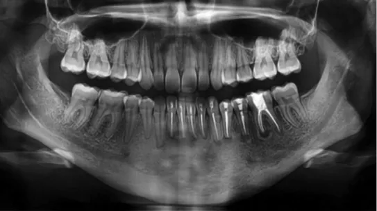 2. ábra Panorámaröntgen-felvétel. Az 1. ábrán jelzett fogak gyökértömései és a gyökércsúcsok reszekciója utáni állapot látható