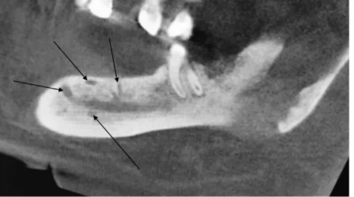 3. ábra CBCT-felvétel. A mandibulában a canalis mandibularis körül  (a nyilakkal jelölt területeken) csontfelritkulások láthatók CBCT = kúpsugaras CT