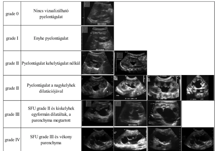 8. ábra. A csecsemőkori hydronephrosis osztályozása SFU alapján, az  ultrahangvizsgálat során látható képpel [83]