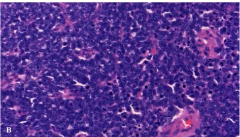 2. ábra Blastemás Wilms tumor szövettani képe (400x) (2. Beteg) 