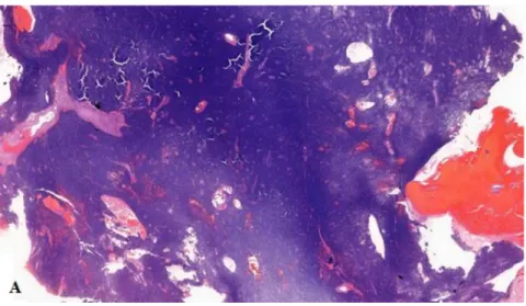 1. ábra Blastemás Wilms tumor szövettani képe (10x) (2. beteg) 