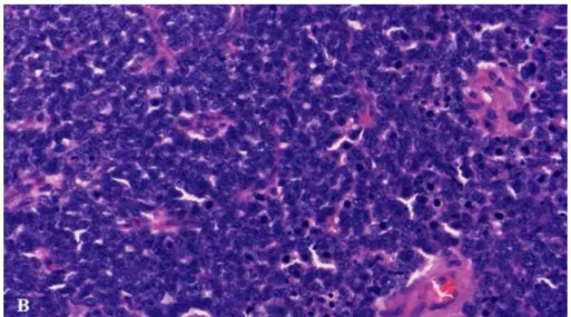 2. figure Blastemal Wilms tumor from one of our samples (Patient 2) (400x)  At 400x magnification (B) (2