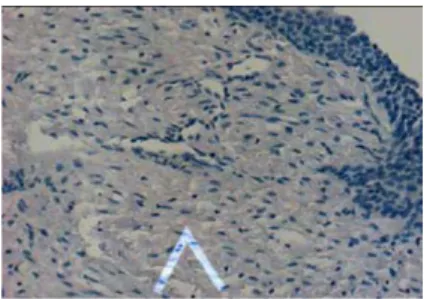 The 3. Figure shows positive expression of VEGF identified by the presence of brown- brown-yellow granules (arrow) in the cytoplasm of endothelial cells in placental tissue (20x)