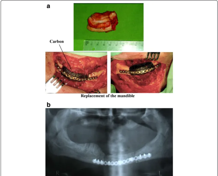 Fig. 1 Compact implants with volumes corresponding to the body of the mandible. a Compact Carbulat ™ implant, after resection of a gingival carcinoma (post