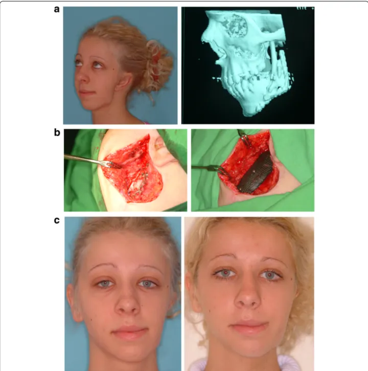 Fig. 3 The bone and soft part deficiency causing the persisting facial asymmetry was corrected with a Carbulat ™ net