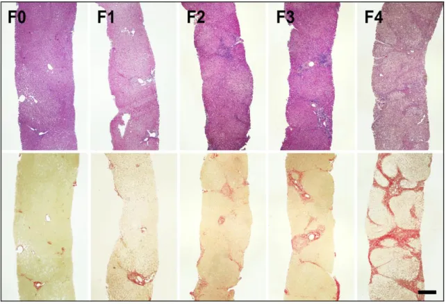 5. ábra Metavir szerinti fibrosis stádiumok. A felső sorban Haematoxillin-eosin  festéssel F0-F4-ig láthatók májbiosziás minták, az alsó sor ugyanezen minták  Picrosisrius festéssel (méretarány 50 μm) 