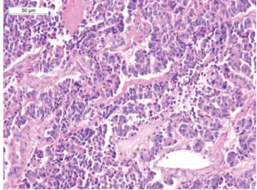 1. ábra Pancreas neuroendokrin tumor. Mirigyes-trabecularis szerke- szerke-zetű daganat (fénymikroszkópos felvétel, hematoxilin-eozin   festés)