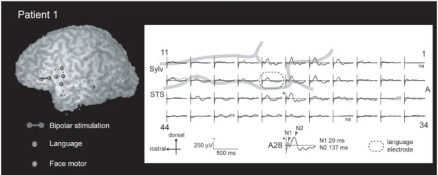 Fig. 7. CCEPs ALPL in patient 1 recorded from the posterior language area  (plate A), time-locked to single pulse electrical stimulation delivered at the anterior  language area