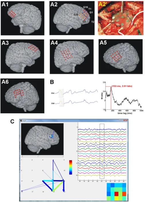 Fig. 15. Recording and analysis of SWA propagation. A, Estimations of the  positions of recording sites on standard human brain images based on  intraoperative photographs and postoperative structural MR images (A1–A6  correspond to Pts