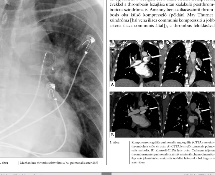 1. ábra Mechanikus thrombuseltávolítás a bal pulmonalis artériából