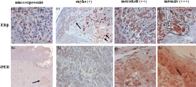 5. ábra. Az ERβ és a GPER citoplazmatikus pozitivitása vagy a festődés hiánya a  melanoma tumorsejtekben és a festődés intenzitásában észlelt különbségek 