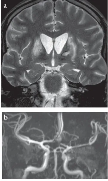1. ábra Infarktus mindkét nucleus caudatusban. A Willis-kör erein szű- szű-kület ábrázolódik (mindkét oldalon az arteria cerebri anterior  A1 és cerebri media M1 szakaszain és a bal a
