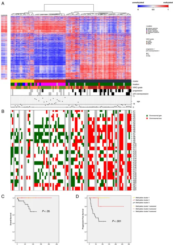 Fig. 1. Methylation profiling of choroid plexus tumors. (A) Heat map of hierarchical clustering of methylation profiles as well as tumor location, neuropathological diagnosis, progression status, p53 status, and patient age