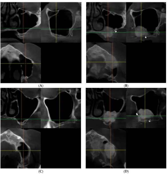 Figure 1. presents  pre‐ and postoperative cone beam  computed  tomography  (cbCT) images  of  the  augmented sinuses in both study groups. (A) preoperative and (B) postoperative images of one of the  patients of  the  BoneAlbumin  group, (C)  preoperative