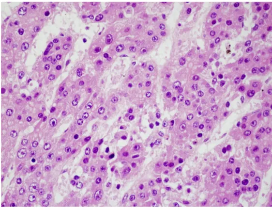 1. ábra: A hepatoblastoma fetális szubtípusának szövettani képe 
