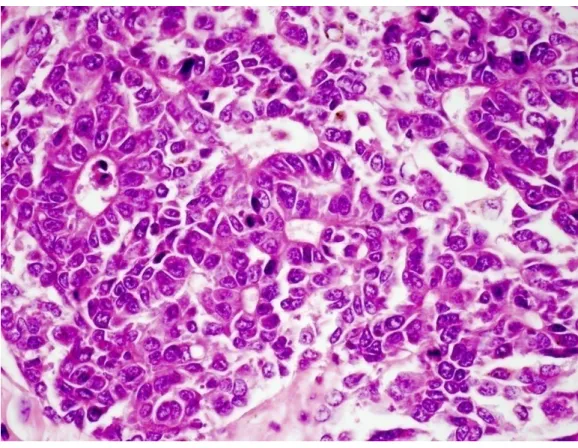 2. ábra: A hepatoblastoma embrionális szubtípusának szövettani képe  A tumorsejtek pszeudorozettákat képeznek