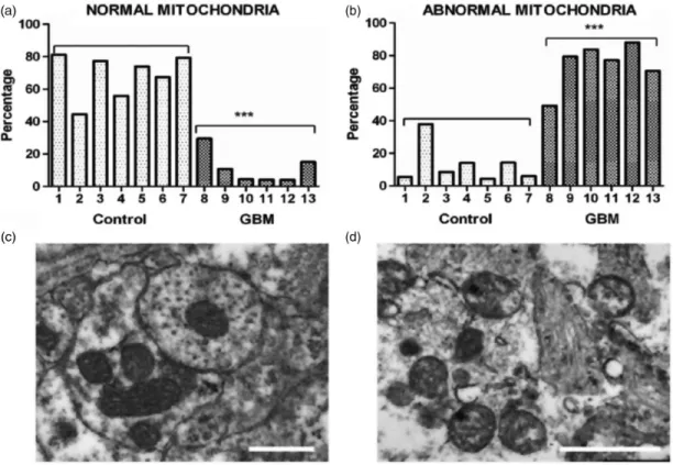 Figure 1. Morphological abnormalities in GBM mitochondria; (a) to (d) (distributed under a Creative Commons license) were repro- repro-duced from Deighton et al
