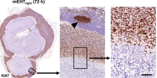 Figure 3. mEHT induced blocking of cell cycle progression. Nuclear Ki67 positivity indicating tumor cell proliferation is ceased in the mEHT damaged central  tumor regions (left), even in cells showing only early signs of apoptosis