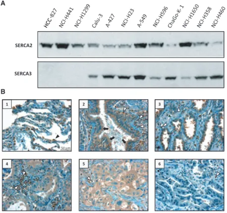 Fig. 1. SERCA expression in lung adenocarcinoma cell lines and lung tumor tissue. (A) Expression of SERCA2 and SERCA3 proteins in untreated lung carcinoma cell lines, detected with the IID8 (SERCA2) and the PLIM430 (SERCA3) monoclonal antibodies by western