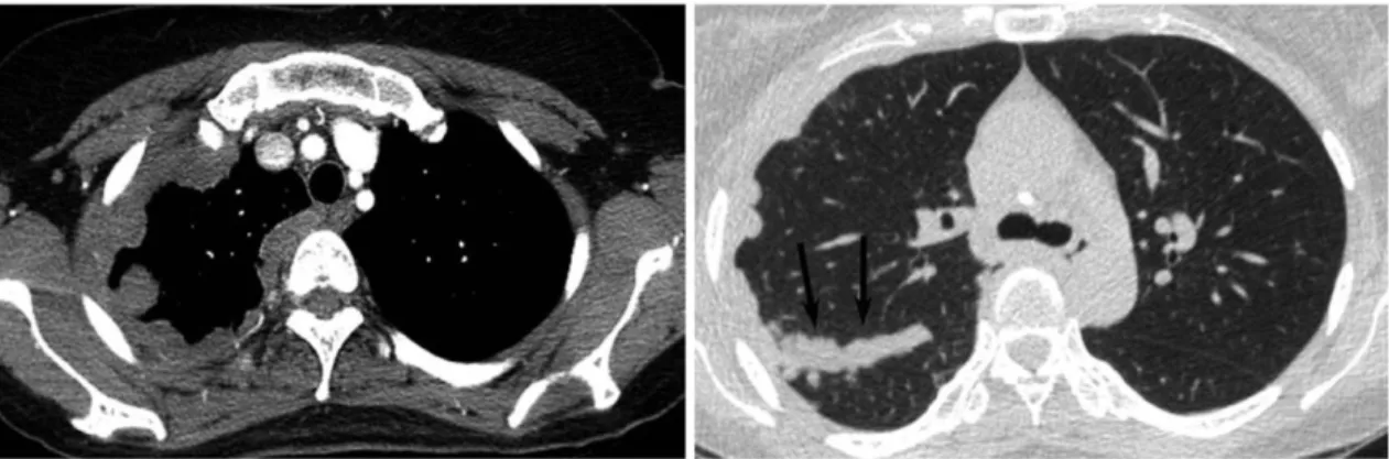 Figure 3. Chest CT scan showing concentric and fissural (arrows) pleural thickening in  the right thoracic cavity corresponding to MPM