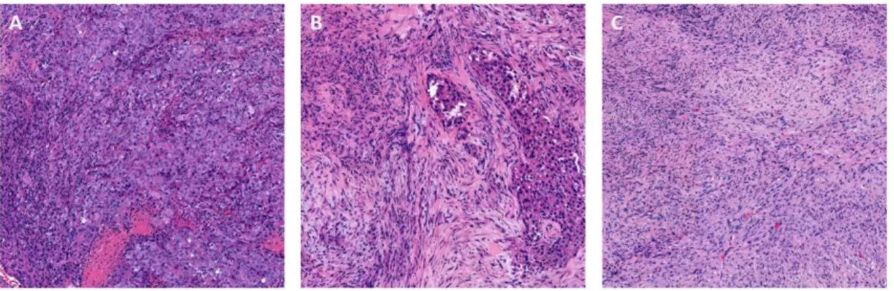 Figure 6. The major histological types of mesothelioma are (A) epithelioid, (B) biphasic  and (C) sarcomatoid
