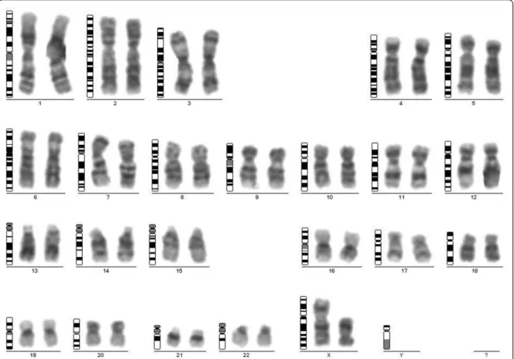 Figure 1 G-banding analysis. The karyotype of the patient with Xq21-q28 deletion of the dominant cell line.