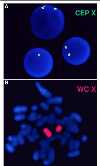 Figure 2 FISH analysis. For FISH analysis using chromosome X centromere specific probe (CEP X) which shows normal female pattern (two green signals) in 90% of cells and X monosomy (one green signal) in 10% of interphase cells (a)