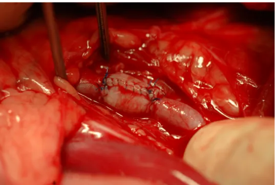Fig. 1a. Picture of the 20-mm-long ARFS autograft right after end-to-end anastomosis between the  bisected ends of the external iliac artery 