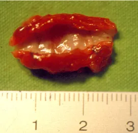 Fig. 1b. Picture of the ARFS autograft after harvesting at revision surgery three months later 