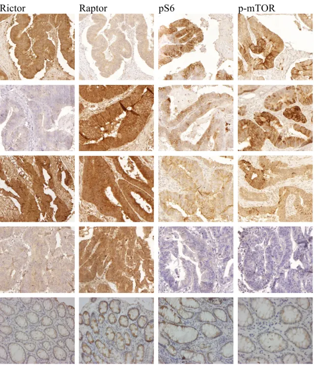 11. ábra.  Fehérje  expressziós  mintázatok  eltérő  mTOR  aktivitású  humán  colon  carcinoma biopsziákban