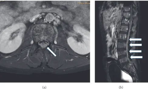 Figure 2: Gadolinium enhanced T1-weighted MRI images of leptomeningeal myeloma of the lumbosacral spine