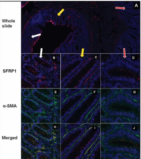 Figure 2. SFRP1 protein expression in a-SMA+ myofibroblasts in NAT, TA and CRC areas in representative photomicrographs