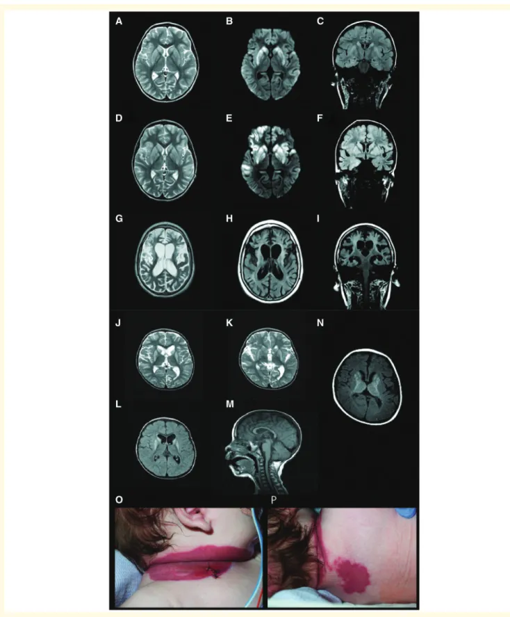 Figure 1 Neuroimaging findings and skin manifestations in children with NAXD mutations