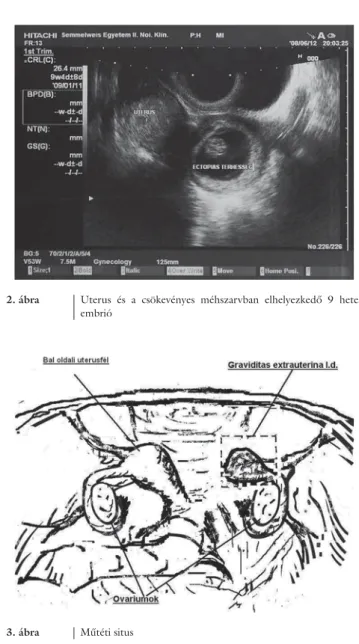 2. ábra Uterus és a csökevényes méhszarvban elhelyezkedő 9 hetes  embrió