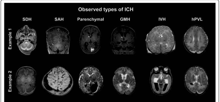 Fig. 2 Observed types of ICH. MR images show two sets of examples for intracranial hemorrhages of different types, locations and sizes observed in asphyxiated infants