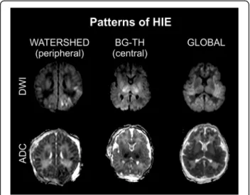Fig. 3 Patterns of HIE. Watershed (peripheral) type of injury, diffusion restriction bilaterally; Basal ganglia – thalamus (central) pattern, restricted diffusion in bilateral thalami and putamina; Global diffusion restriction on DWI and ADC