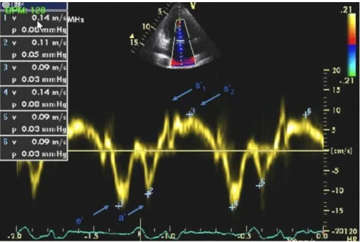 Figure 4. Pulsed Doppler tissue Doppler imaging (TDI) of the mitral annulus. s‟ 1 :tissue  velocity wave in the isometric contraction period, s‟ 2 :velocity wave in the ejection  period, e‟ and a‟: velocity wave in early and late diastolic periods, respect