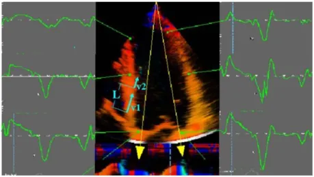 Figure  5 . Tissue  Doppler derived strain imaging. The difference in velocities (velocity  gradient) between two different regions (v 1  and v 2 ) at a known distance (L) is measured; this  allows for the calculation of strain rate (SR): (v 1 -v 2 )/ L; S