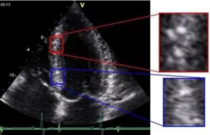 Figure 6. Typical speckle pattern in the myocardium. The two enlarged areas show  completely different speckle patterns, which is due to the randomness of the 