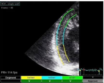 Figure 8. Speckle tracking of the lateral wall (apical 4 chamber, narrow view) in a  patient with overt isolated left ventricular non-compaction