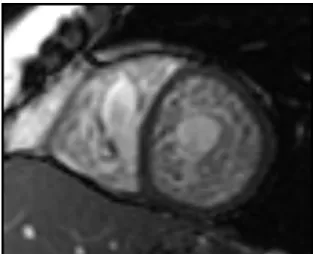 Figure 9. Short axis cardiovascular magnetic resonance (CMR) of a steady state free  precession (SSFP) image illustrating severe myocardial trabeculation with deep 
