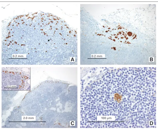 Fig 1. Examples of sentinel node (SN) metastases from lobular breast carcinoma that caused difficulty in nodal  classifica-tion and discordance between different interpretations