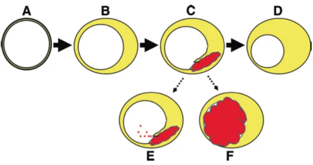 Figure 3 – Evolution of atherosclerotic plaque.  