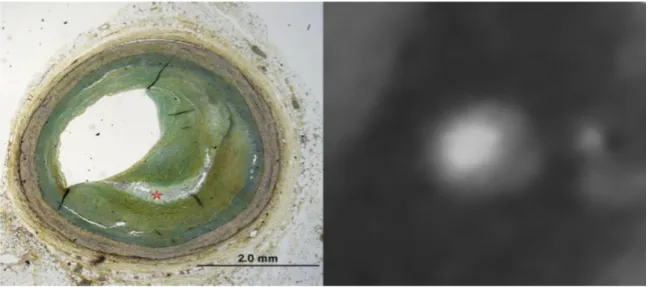 Figure 5 – (Early) fibroatheroma as classified by histology.  