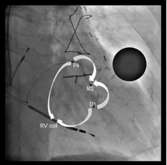 Figure 1. Right anterior oblique fluoroscopic view of seventh patient, representing the  four  analyzed  pacing  vectors  between  the  quadripolar  LV  lead  electrodes  and  right  ventricular  (RV)  coil
