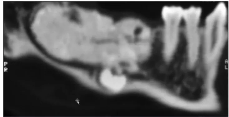 2. kép:  A CT felvételen jól látható az odontoma,   a diszlokált moláris fog és a canalis mandibulae lefutása