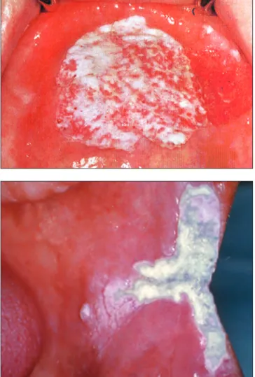 7. kép:  A stomatitis protetica (denture stomatitis) tipikus képe,   csak a protézis alaplemezével érintkező palatinális nyálkahártya gyulladt 