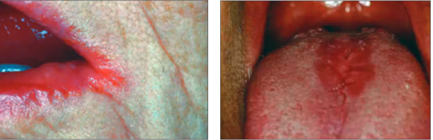 12. kép a, b:  A krónikus candidainfekcióval társuló glossitis mediana rhombica (median romboid glossitis)  a) vagy kiemelkedik a nyelv felszínéből,  b) vagy belesimul a környezetébe