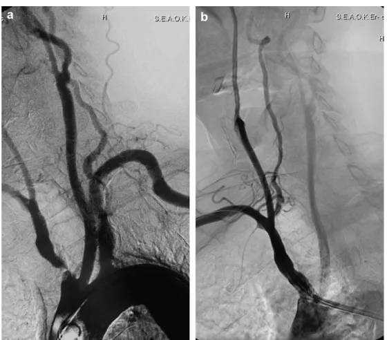 Figure 2 a and b. Successful PTA and stent (10  19 mm Genesis, Cordis Corp, Miami, Fla) deployment in the innominate artery of a 67-year-old symptomatic female patient with upper limb claudication